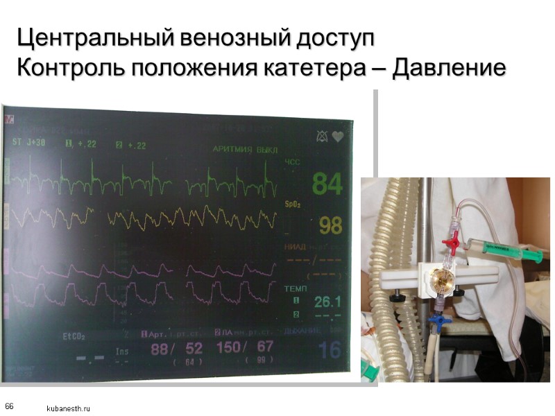 66 Центральный венозный доступ Контроль положения катетера – Давление